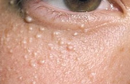 Causes of White Spots Around Eyes and How to Remove