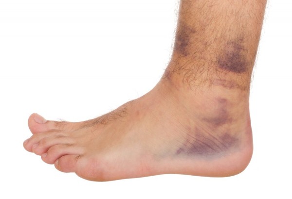 causes of random bruises on legs