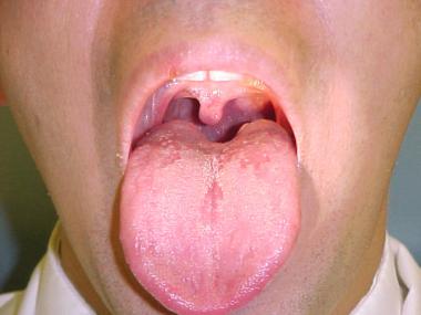 Throat obstruction