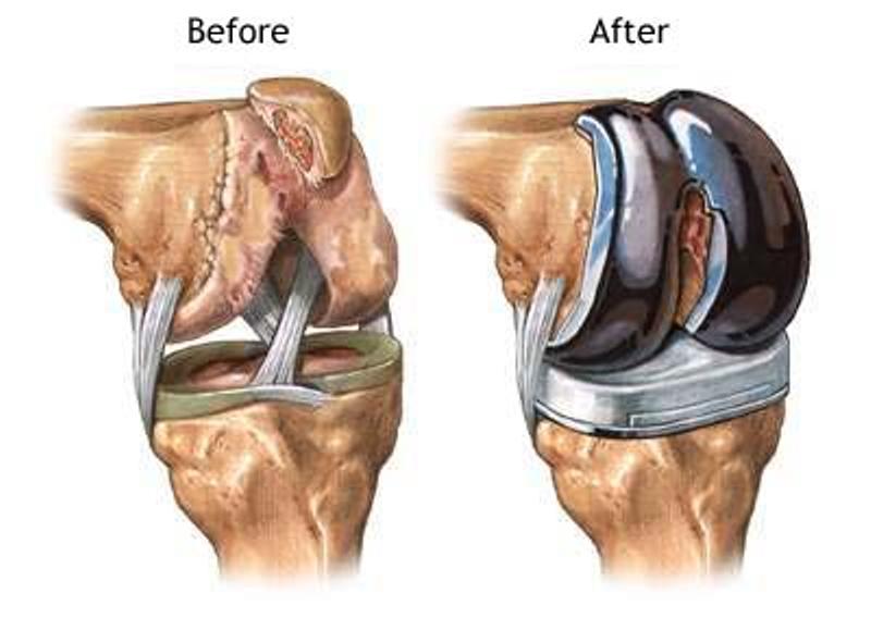 Bilateral Knee Replacement