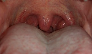 uvula swollen