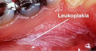 oral leukoplakia