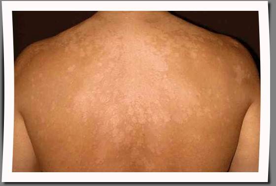 Pityriasis Tinea Versicolor Causes Symptoms And Treatment