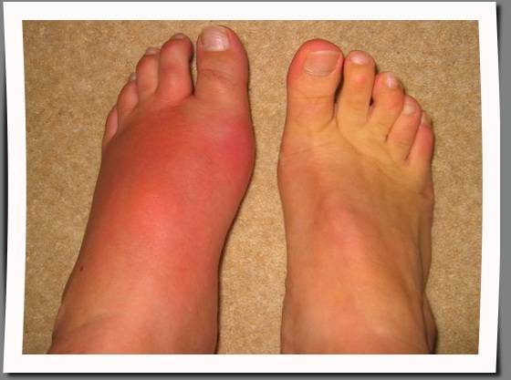 Inflamed Swollen Feet 23