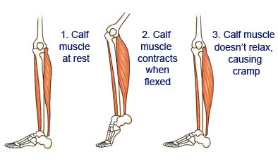 leg cramps in calves and thighs at 14 weeks pregnant