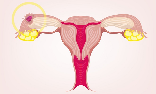 difference between bleeding and a period