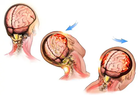 concussion symptoms