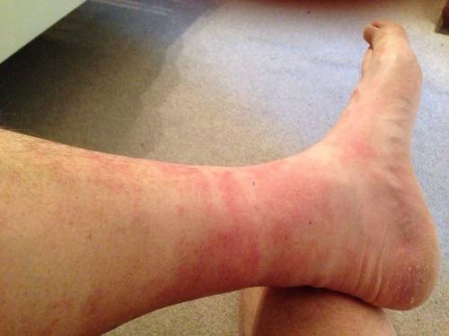 rash on ankles after walking
