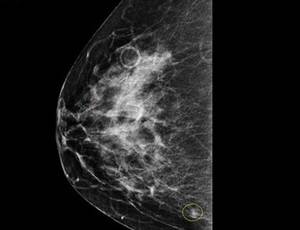 fibrocystic breasts (mammography image)