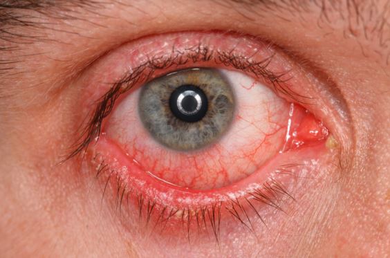 sharp pain in eye socket