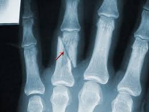 broken finger - x-ray