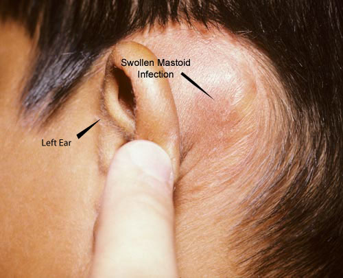 headaches behind ear left side