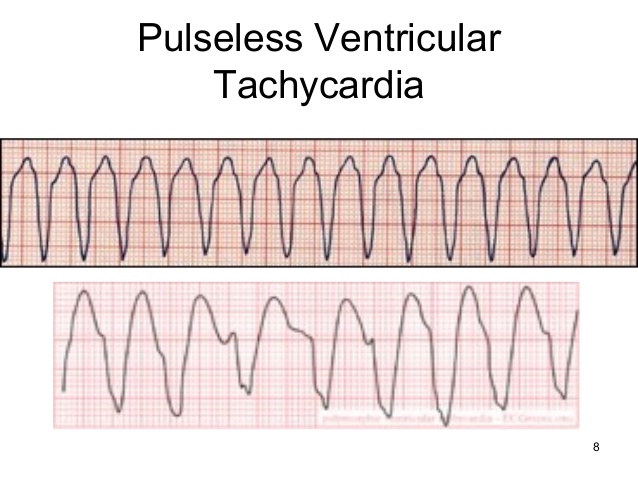  pulseless ventricular tachycardia is life-threatening. 