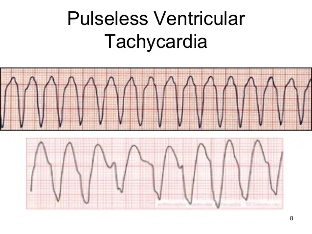 ventricular fibrillation pulseless electrical activity ecg