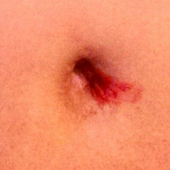 Belly Button Bleeding