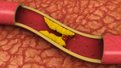 Cholesterol 