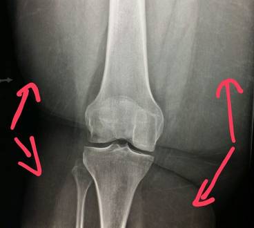 obesity and painful joints