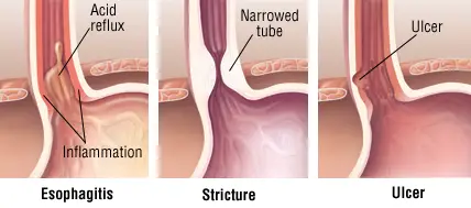 Natural Home Remedies for Severe GERD &amp; Heartburn | IYTmed.com