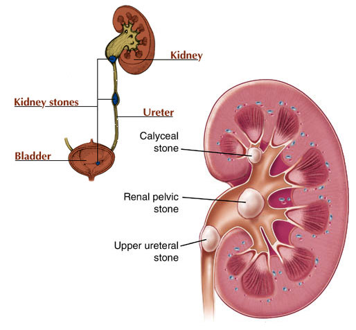 signs of kidney stones in guys