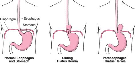 Many people with a hiatal hernia