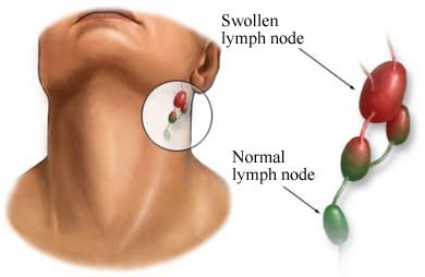 Swollen Lymph Nodes in neck symptoms