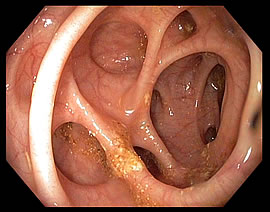 diverticulitis