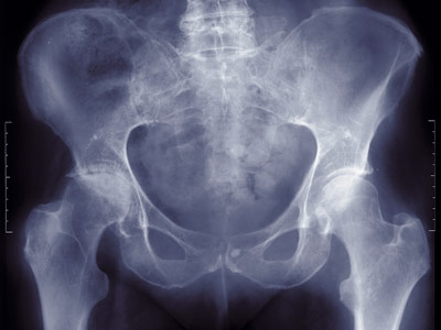 hip pain in young females