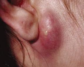 Causes and Treatments of Painful Lump Behind Ear | IYTmed.com