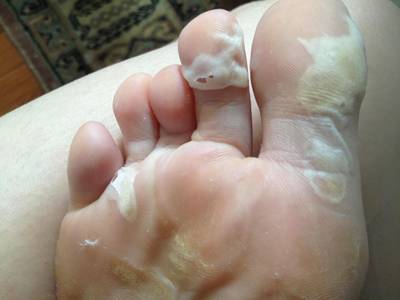 how to fix dry peeling skin on feet