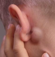 Lump Behind Ear