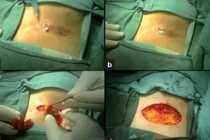 Cyst of tailbone removal surgery