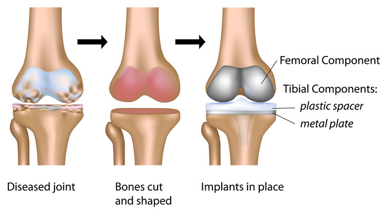 Hurt after total knee replacement