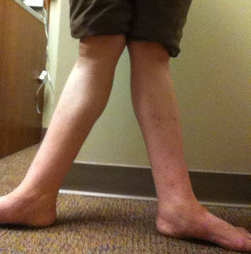 Pain in Back of Knee After Hyperextension: Causes and ...