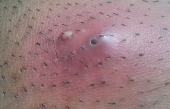 Treatment for Infected Ingrown Pubic Hair