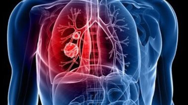  lung cancer pain