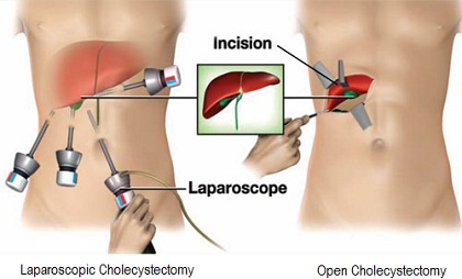 Cholecystectomy is performed using general anesthesia, so you will not be aware during the procedure. Anesthesia drugs are offered through a vein in your arm. As soon as the drugs take effect, your health care team will place a tube down your throat to help you breathe. Your specialist then performs the cholecystectomy using either a laparoscopic or open procedure. Credits: zadehsurgical.com