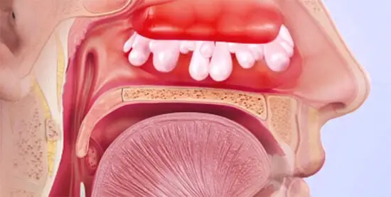 mucus-in-nose-for-weeks-page-2-of-2-iytmed