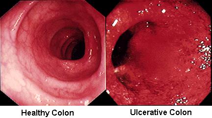 ulcerative colitis