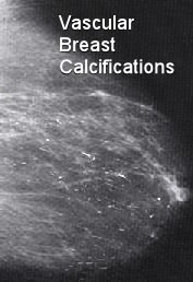 breast calcifications after breast cancer