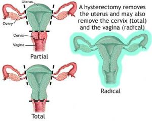 Partial Hysterectomy