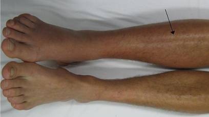 blood clots in legs and feet