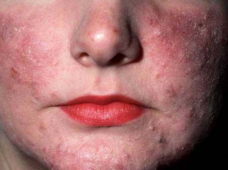 rosacea in women