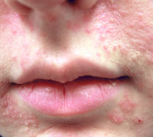 Perioral Dermatitis