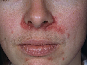 dry skin around mouth and nose
