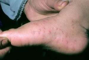 coxsackie virus rash pictures