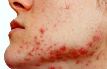 polycystic ovarian syndrome acne help