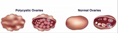 polycystic ovary syndrome causes