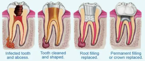 how long does a root canal procedure take