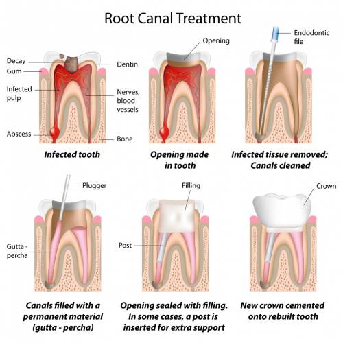 how long does a root canal take