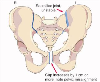 pain on left side of pelvic bone during pregnancy